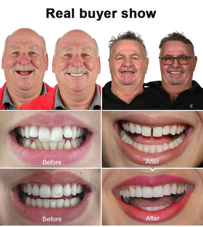 Ultimate Smile Trainer - Instantly Perfect Your Smile